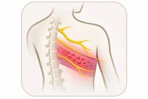 Neuralgia postherpética