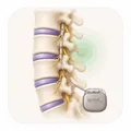 Neuromodulación espinal